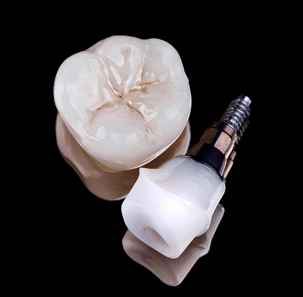 Screw-retained,Or,Cemented,